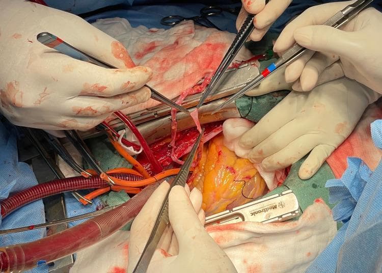 A high-detail intraoperative clinical photograph documenting a coronary artery bypass graft (CABG) procedure. The surgical field displays a median sternotomy with the heart exposed and positioned for distal anastomosis. The central focus is the exposure and manipulation of the diagonal artery using fine surgical forceps. Multiple gloved hands are visible, coordinating the retraction of the epicardium and the stabilization of the target vessel. Cardiopulmonary bypass (CPB) is active, indicated by the presence of large-bore arterial and venous cannulae (red and orange tubing) and a sternal retractor labeled with medical instrumentation branding. Visible anatomical structures include the epicardial surface of the heart, coronary vasculature, and surrounding mediastinal tissues. The use of gauze sponges and fine sutures is evident, facilitating a clear operative field for precise vascular microsurgery. This image serves as an educational resource for cardiac surgery, demonstrating vessel exposure techniques and the configuration of the surgical field during complex bypass maneuvers.