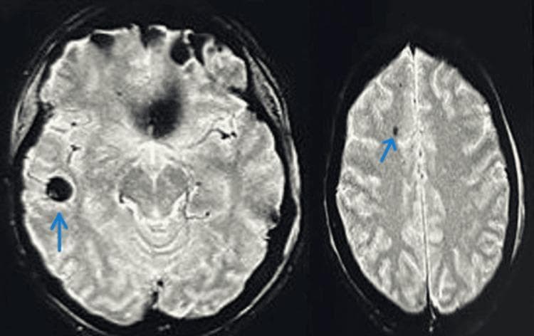 This diagnostic imaging set consists of two axial MRI brain slices demonstrating cerebral fat embolism syndrome. The images show bilateral, multifocal lesions characterized by 'starfield pattern' hypointensities. Blue arrows highlight specific small, circular-to-ovoid hypointense (dark) foci within the cerebral hemispheres, particularly visible in the right temporal lobe and the left frontal subcortical white matter. These lesions represent microhemorrhages or localized infarcts secondary to fat emboli following traumatic fractures. The anatomical structures, including the cerebral gyri, sulci, and ventricular system, are otherwise well-preserved without evidence of midline shift, mass effect, or significant herniation. The MRI findings illustrate the characteristic neurological manifestation of systemic fat embolism, emphasizing the diagnostic value of magnetic resonance imaging in patients presenting with altered mental status or neurological deficits post-trauma. The specialty is neuroradiology, suitable for intermediate to advanced medical education regarding traumatic brain injury complications.