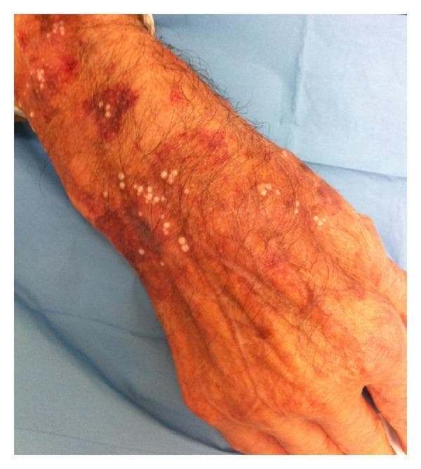 This clinical photograph displays the dorsal aspect of a human forearm and hand exhibiting classic cutaneous adverse effects from chronic, high-potency topical corticosteroid use. The image demonstrates a triad of clinical signs: rubeosis steroidica, senile-like purpura, and secondary milia. The background skin appears atrophic with prominent wrinkling and visible vasculature. A mottled, erythematous-to-brownish flushing (rubeosis steroidica) is observed throughout the hand and wrist. Superimposed on this are dark reddish-purple, irregular macules and patches of purpura, particularly concentrated on the distal forearm. Additionally, numerous small (1-2 mm), discrete, pearly-white, raised papules consistent with milia are scattered across the purpuric and erythematous regions. These findings illustrate the structural and vascular compromise of the dermis resulting from prolonged glucocorticoid therapy, useful for dermatological education on iatrogenic skin conditions.