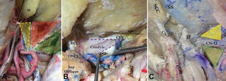 This composite of three anatomical photographs (A-C) illustrates deep neurosurgical triangles of the suboccipital and condylar regions, essential for approaching the jugular foramen (JF). Panel A shows the suboccipital triangle (green), condylar triangle (red), and jugular triangle (yellow), bounded by the superior oblique, inferior oblique, and rectus capitis lateralis (RCL) muscles. Notable vascular structures include the external and internal carotid arteries (ECA, ICA). Panel B highlights the deep condylar and trans-condylar triangles (purple), bounded by the condylar emissary vein (CEV), RCL, and the transverse process of the atlas (TP-C1). The occipital condyle and atlanto-occipital joint (OCJ) are visible after mobilizing the vertebral artery (VA). Panel C demonstrates the supra-hypoglossal (yellow) and infra-hypoglossal (green) triangles after condyle drilling. These triangles serve as surgical corridors to the infrajugular area and OCJ. Key neural landmarks include the facial nerve (CN-7) and hypoglossal nerve (CN-12) near the jugular foramen and the artery of the stylomastoid foramen (aSMF).