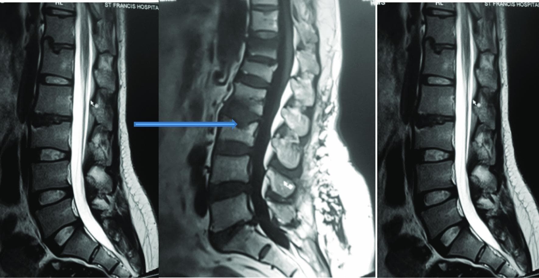 This diagnostic image consists of T2-weighted sagittal MRI sequences of the lumbar spine, demonstrating degenerative changes. A key finding is intervertebral disc desiccation at the L2/L3 level, characterized by a visible loss of high signal intensity (darkening) compared to the hyperintense signal of adjacent hydrated discs. Additionally, the image illustrates Schmorl's nodes at the L1 and L3 vertebral bodies. A blue arrow highlights a Schmorl's node, which appears as a focal, rounded indentation or herniation of the intervertebral disc material through the vertebral endplate into the spongy bone of the vertebral body. The spinal cord and conus medullaris are visible, with the cerebrospinal fluid appearing bright on this T2-weighted sequence. The images provide a clinical demonstration of common lumbar spinal pathologies, specifically focusing on disc degeneration and endplate herniation, which are relevant in the diagnostic evaluation of chronic low back pain.
