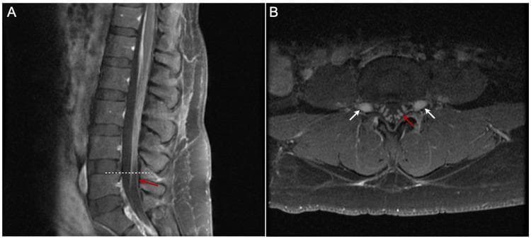 Diagnostic MRI images of the lumbar spine in a patient with Guillain-Barré syndrome (GBS). Panel A shows a post-contrast fat-suppressed sagittal T1-weighted image, while Panel B displays a corresponding axial T1-weighted image. The imaging reveals prominent, smooth thickening and linear contrast enhancement of the cauda equina nerve roots (indicated by red arrows) and the exiting spinal nerve roots (indicated by white arrows in the axial view). These findings are characterized by high signal intensity compared to the surrounding cerebrospinal fluid and neural tissues, reflecting a breakdown of the blood-nerve barrier. The absence of nodularity or clumping suggests an acute inflammatory demyelinating process rather than a neoplastic or infectious etiology. This imaging pattern is a classic radiological manifestation of inflammatory polyradiculoneuropathy, such as acute inflammatory demyelinating polyradiculoneuropathy (AIDP) seen in GBS cases.