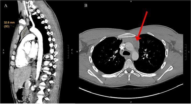 This figure presents contrast-enhanced computed tomography (CT) scans of the chest in sagittal (A) and axial (B) planes, focused on the mediastinum. Panel A shows a sagittal reconstruction illustrating a soft tissue mass within the anterior mediastinal space, specifically located in the left lobe of the thymus. A digital measurement indicates the lesion's long axis is approximately 32.6 mm. Panel B provides an axial view at the level of the great vessels, where a red arrow highlights a well-circumscribed, heterogeneous nodular mass. The lesion demonstrates areas of central low density, suggestive of cystic changes or necrosis within the thymic tissue. Key anatomical landmarks visible include the sternum, ascending aorta, and vertebral bodies. This diagnostic imaging is characteristic of an anterior mediastinal tumor, clinically diagnosed in this case as a primary mediastinal seminoma. The images are essential for teaching the differential diagnosis of anterior mediastinal masses (the 'four Ts': thymoma, teratoma, 'terrible' lymphoma, and thyroid) and demonstrating the use of multi-planar CT imaging for tumor localization and characterization.