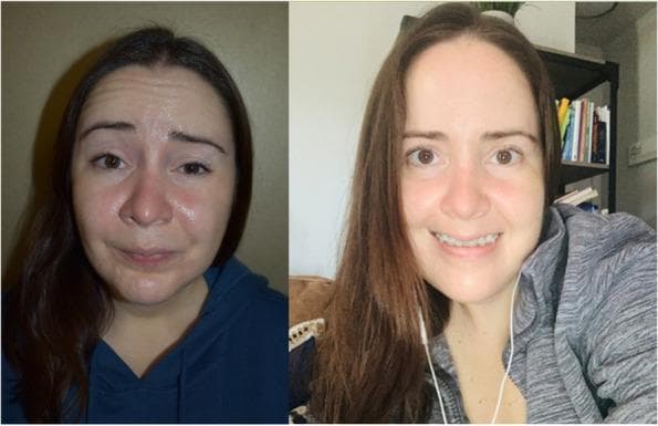 This clinical photograph set provides a side-by-side comparison of a 32-year-old female patient with chronic left-sided facial paralysis. The left image represents the baseline state three years post-TMJ surgery, showing classic signs of lower motor neuron facial nerve palsy. Key visible findings include left-sided brow ptosis, flattening of the horizontal forehead wrinkles on the left with compensatory overactivity on the right, widening of the palpebral fissure (lagophthalmos), and loss of the nasolabial fold. The oral commissure droops on the left, resulting in facial asymmetry during attempted expression. The right image shows the patient one month after extracellular vesicle (EV) treatment, demonstrating significant clinical improvement. There is a restoration of facial symmetry, improved resting muscle tone, and regained ability to perform a symmetrical smile. The nasolabial folds appear balanced, and brow positioning is more uniform. This comparison illustrates the recovery from severe facial nerve impairment (House-Brackmann scale) to mild dysfunction following therapeutic intervention.