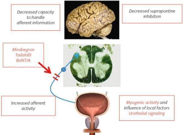 A pathophysiology diagram illustrating the neural pathways and pharmacological targets associated with overactive bladder (OAB). The visual comprises a clinical photograph of a human brain, a histological cross-section of the spinal cord, and an anatomical illustration of the urinary bladder. A blue line indicates the ascending afferent signal pathway originating from the bladder, where text boxes highlight 'increased afferent activity,' 'myogenic activity,' and 'urothelial signaling' as local drivers of dysfunction. The pathway ascends through the spinal cord toward the brain. Central nervous system involvement is annotated with 'decreased suprapontine inhibition' and a 'decreased capacity to handle afferent information,' explaining the loss of cortical control over voiding. Pharmacological intervention is represented by a red arrow pointing to a block in the afferent pathway, listing therapeutic agents including Mirabegron, Tadalafil, and Botulinum neurotoxin A (BoNT/A). This diagram serves as an educational tool for urology and neurology, detailing the communication between the peripheral organ and the central nervous system in lower urinary tract symptoms.
