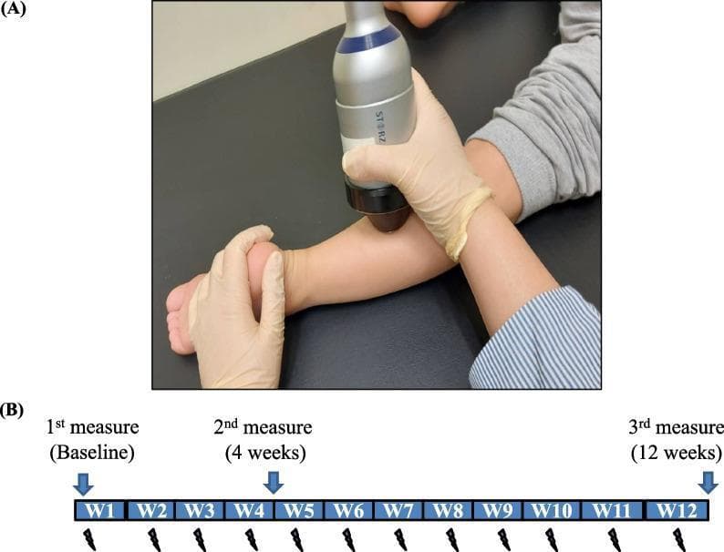 This composite educational graphic consists of a clinical photograph and a corresponding study timeline. Part (A) is a procedural photograph showing Extracorporeal Shock Wave Therapy (ESWT) being administered to the lower extremity of a pediatric patient. A clinician's gloved hand applies the applicator tip of a Storz medical device to the posterior calf region (gastrocnemius-soleus complex), while another gloved hand stabilizes the foot in a neutral position. Part (B) presents a horizontal timeline diagram outlining a 12-week therapeutic protocol. The timeline is divided into weekly segments (W1–W12). Weekly treatment sessions are denoted by lightning bolt icons below each segment. Outcome assessment points are marked with blue downward arrows at three intervals: 1st measure (Baseline at W1), 2nd measure (4 weeks), and 3rd measure (12 weeks). The visual demonstrates the practical application and research design for treating spasticity or muscle contractures using shock wave therapy.