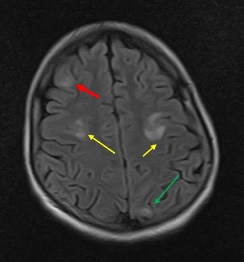 This diagnostic image is an axial T2-Fluid Attenuated Inversion Recovery (FLAIR) MRI scan of the brain. The image displays multiple, multifocal hyperintense lesions within the cortical and subcortical white matter, representing vasogenic edema. Colored arrows highlight the specific anatomical distribution of these findings: a red arrow points to a hyperintense lesion in the right frontal lobe; yellow arrows indicate bilateral hyperintensities in the parietal lobes; and a green arrow identifies a smaller area of increased signal in the left occipital lobe. These asymmetrical, high-signal regions are characteristic of conditions causing disruption of the blood-brain barrier, such as Posterior Reversible Encephalopathy Syndrome (PRES) or other metabolic encephalopathies. The image serves as a clinical teaching tool for identifying typical signal intensities and lobar involvement in neurological disorders presented via MRI sequencing.
