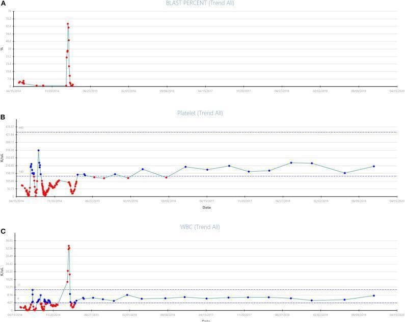 A composite clinical chart comprising three longitudinal line graphs (A, B, and C) tracking hematologic parameters in a patient over a multi-year period (2014–2020) during treatment for leukemia.
Graph A (Blast Percent) displays a sharp, transient spike in peripheral blast percentage reaching approximately 70% in late 2014, followed by a rapid decline and sustained suppression near 0% through 2020, indicating successful induction of remission.
Graph B (Platelet Trend) shows significant initial fluctuations in platelet count (range ~50–350 K/uL) before stabilizing within the normal to near-normal range (150–200 K/uL) following the initiation of combination therapy.
Graph C (WBC Trend) illustrates a concurrent leukocytosis peak (~36 K/uL) coinciding with the blast crisis in late 2014, followed by stabilization within a normal range of 4–8 K/uL.
These charts demonstrate the clinical efficacy of Vidaza (azacitidine) and Sorafenib in maintaining molecular and hematologic response in a patient with FLT3-mutated acute myeloid leukemia (AML).