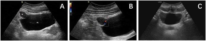 This set of diagnostic images consists of three transabdominal ultrasound panels (A, B, and C) focused on the urinary bladder. Panel A is a grayscale B-mode image showing a well-demarcated, hypoechoic mass measuring approximately 2.6 x 1.8 cm located at the anterior superior aspect (bladder dome), consistent with an urachal lesion. The mass displays an irregular shape and heterogeneous internal echogenicity. Panel B utilizes Color Doppler Flow Imaging (CDFI), demonstrating sparse, dot-linear blood flow signals primarily localized at the peripheral margins of the hypoechoic mass. Panel C represents a follow-up grayscale ultrasound showing a normal bladder configuration with no evidence of the previously seen mass, indicating successful surgical resection or resolution. These images are clinically significant for evaluating urachal pathologies, such as urachal PEComas or abscesses, and documenting treatment outcomes in urological oncology.