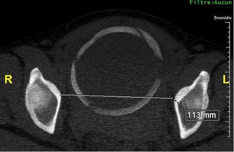 This diagnostic image is an axial Maximum Intensity Projection (MIP) reconstruction from a computed tomography (CT) scanopelvimetry. It provides a cross-sectional view of the female pelvic inlet and outlet for obstetric assessment. The central feature is the sacrum, appearing as an oval bony ring, flanked laterally by the iliac and ischial bones of the pelvis. Orientation is clearly marked with 'R' for the patient's right and 'L' for the patient's left. A linear measurement is demonstrated using a horizontal calliper line connecting the inner margins of the ischial bones. This line measures the median transverse diameter, which is annotated with a numerical value of 113 mm. Technical metadata in the upper right corner indicates a scale of '5mm/div' and the absence of a digital filter ('Filtre: Aucun'). This imaging modality is primarily used in clinical obstetrics to evaluate for pelvic narrowing and assess the adequacy of the birth canal for vaginal delivery.