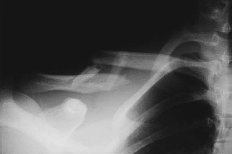 This diagnostic image is an anteroposterior (AP) X-ray radiograph of the shoulder and upper thoracic region, demonstrating a displaced mid-shaft clavicle fracture. The primary finding is a complete cortical disruption of the middle third of the clavicle with 100% displacement and significant shortening exceeding 2 cm. The fracture is comminuted, with at least one visible 'butterfly' fragment present at the fracture site. The medial fragment is superiorly displaced due to the pull of the sternocleidomastoid muscle, while the lateral fragment is depressed. The surrounding anatomy, including the visible upper ribs, coracoid process, and scapula, appears intact without obvious secondary trauma or pneumothorax in this view. This image is an educational example of severe clavicle injury typically requiring surgical intervention, such as intramedullary pinning or plate fixation, particularly in the context of high-grade shortening and displacement.