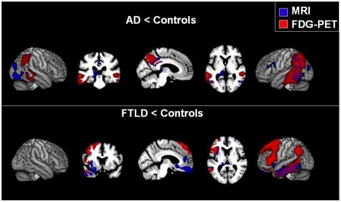 This diagnostic comparison chart displays neuroimaging results for Alzheimer’s disease (AD) and Frontotemporal Lobar Degeneration (FTLD) relative to healthy controls. The image utilizes statistical parametric mapping overlaid on brain templates in sagittal, coronal, and axial views. Red clusters indicate glucose hypometabolism (FDG-PET), blue clusters represent cortical atrophy (structural MRI), and violet regions show where atrophy and hypometabolism overlap. The upper panel (AD < Controls) demonstrates a characteristic pattern of hypometabolism in the parieto-mesial cortex, specifically the precuneus and posterior cingulate, with bilateral involvement of the lateral temporal and inferior parietal regions. The lower panel (FTLD < Controls) shows a distinct distribution concentrated in the fronto-median and fronto-lateral cortex, as well as the insula, with a marked lateralization to the left hemisphere. This visualization highlights the differential topographical patterns of neurodegeneration used to distinguish these two common forms of dementia through functional and structural imaging modalities.