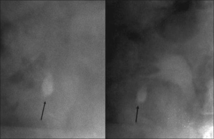 This diagnostic image displays two radiographic views (KUB or fluoroscopy) of the renal region, specifically illustrating nephrolithiasis. In both panels, a prominent, radiopaque, oval-shaped calculus is identified by a black arrow. The stone is situated in the lower pole of the kidney, likely within an inferior calyx. The surrounding renal architecture exhibits varying shades of gray density, with faint outlines of the collecting system and renal parenchyma visible against the darker background of the abdominal cavity. The image serves as a clinical example of complex lower-pole renal calculi, highlighting the challenges of surgical access for percutaneous nephrolithotomy (PCNL) due to the acute angles within the calyces. This material is designed for urological education, focusing on the localization and radiographic identification of renal stones prior to interventional procedures.