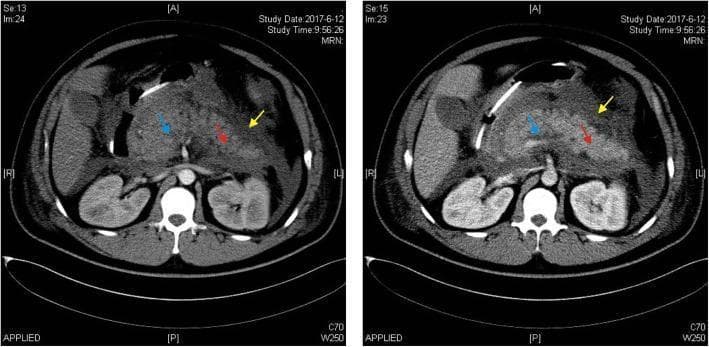 This diagnostic image consists of two side-by-side axial abdominal CT scans demonstrating features of severe acute pancreatitis. The left panel shows a non-contrast (plain) CT, while the right panel shows a contrast-enhanced CT. The pancreas is diffusely enlarged (edematous) with a significant loss of the normal sharp margins and disappearance of clear peripancreatic adipose tissue planes. Colored arrowheads on the enhanced scan identify key pathological findings: the blue arrowhead points to a hypo-enhancing region representing an acute necrotic collection; the red arrowhead indicates areas of pancreatic edema; and the yellow arrowhead highlights an acute peripancreatic fluid collection (APFC). The contrast-enhanced image is critical for distinguishing between viable, enhancing pancreatic parenchyma and non-enhancing necrotic tissue. There is a visible water-density shadow in the peripancreatic space, characteristic of inflammatory exudate. This comparison is used in medical education to illustrate the diagnostic criteria and complications of pancreatitis according to the Atlanta consensus.
