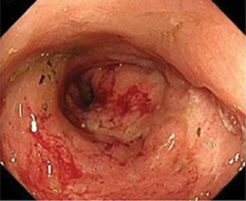 This clinical photograph shows an endoscopic view of the gastric lumen, highlighting a large, irregular giant ulcer characteristic of advanced gastric cancer. The gastric mucosa is significantly distorted with prominent inflammatory changes and irregular thickening. The ulcer base is covered with a thick, whitish fibrinous exudate and areas of necrotic tissue. Active bleeding is visible, evidenced by fresh bright red blood on the ulcer surface and adjacent mucosa. The margins of the lesion appear raised and nodular, suggesting a malignant process rather than a benign peptic ulcer. The surrounding gastric folds are blunted and erythematous, indicating reactive gastritis. This image serves as an educational example of advanced primary gastric malignancy (cT4b) and illustrates the visual indicators of high-grade pathology, including size, friability, and morphological irregularity in a patient undergoing systemic and targeted oncological therapy.