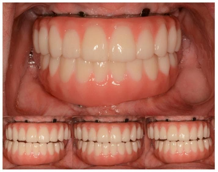 This composite intraoral clinical photograph displays maxillary and mandibular definitive complete-arch implant-supported prostheses in a patient with Sjögren's syndrome. The large top panel illustrates the prostheses in centric occlusion, showing a balanced arrangement of off-white artificial teeth and pink gingiva-colored prosthetic bases that mimic natural soft tissue morphology. The three smaller bottom panels demonstrate functional occlusal dynamics: lateral excursions (left and right) and protrusive excursion (center). The lateral views show working-side contacts without posterior interferences, while the protrusive view demonstrates anterior guidance, where the mandibular incisors slide along the palatal surfaces of the maxillary incisors. This visual documentation serves as an educational example of successful prosthetic rehabilitation using titanium-zirconia and monolithic zirconia materials to restore aesthetics and function in complex restorative cases.