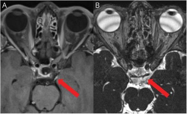 This diagnostic image consists of two axial cranial MRI slices focusing on the skull base and midbrain. Image A is a T1-weighted post-contrast sequence showing smooth, linear gadolinium enhancement of the cisternal segment of the left oculomotor nerve (CN III), indicated by a red arrow. The enhancement suggests an inflammatory or neoplastic process. Image B displays the same anatomical region using a 3D Constructive Interference in Steady State (CISS) sequence, which provides high-resolution visualization of cranial nerves against the hyperintense cerebrospinal fluid (CSF). In image B, the red arrow points to the oculomotor nerve within the prepontine cistern, allowing for assessment of the nerve's morphology and its relationship with adjacent structures like the posterior cerebral and superior cerebellar arteries. Anatomical landmarks visible in both frames include the globes, orbital structures, the sphenoid sinus, and the midbrain. This comparison illustrates the clinical utility of utilizing both post-contrast and heavily T2-weighted steady-state sequences to evaluate cranial nerve pathology such as oculomotor nerve palsy.