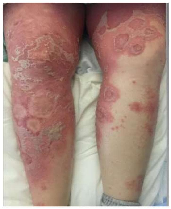 Clinical photograph of the lower extremities demonstrating generalized pustular psoriasis (von Zumbusch type). The image shows extensive, confluent erythematous plaques covering large areas of the thighs and legs. Numerous small, sterile, non-follicular pustules are visible, often coalescing into larger 'lakes of pus.' Notable features include significant epidermal disruption characterized by widespread desquamation, peeling skin, and areas of denuded epidermis, particularly prominent on the anterior thighs and knees. Some lesions exhibit an annular or circinate morphology with active pustulation at the advancing edges and central clearing or scaling, representing different stages of lesion evolution. The clinical presentation highlights severe cutaneous inflammation and a compromised skin barrier, which are hallmarks of a GPP flare. This visual is essential for medical students and dermatologists to differentiate between stable plaque psoriasis and acute pustular variants, as well as considering differential diagnoses like Acute Generalized Exanthematous Pustulosis (AGEP).