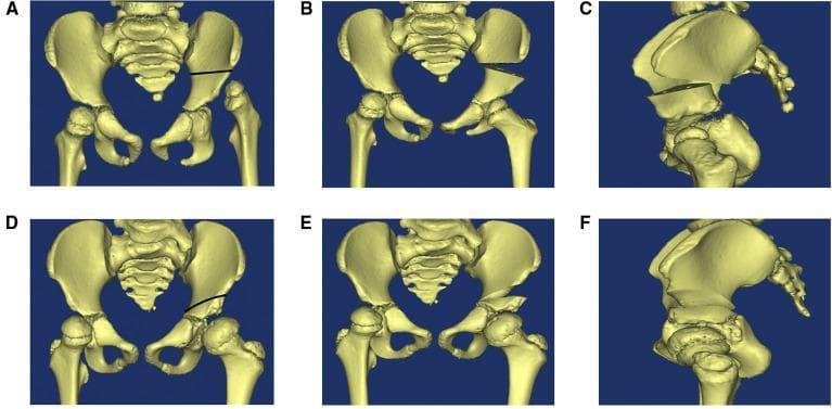 This medical visual compares the structural changes following two common pediatric pelvic osteotomies for developmental dysplasia of the hip (DDH): the Salter and Pemberton procedures. The content consists of 3D CT reconstructions of a pediatric pelvis in six panels (A–F).
Panels A–C demonstrate the Salter innominate osteotomy. Panel A shows a complete horizontal osteotomy line extending from the sciatic notch to the anterior inferior iliac spine. Panel B (anteroposterior) and C (lateral) show the resulting complete separation and downward/forward rotation of the distal pelvic fragment, creating a visible gap above the acetabulum typically filled with a bone graft.
Panels D–F demonstrate the Pemberton pericapsular osteotomy. Panel D shows an incomplete osteotomy line curving from the ilium toward the triradiate cartilage. Panels E (anteroposterior) and F (lateral) illustrate that the posterior column remains intact; the acetabular roof is hinged downward through the triradiate cartilage, altering the acetabular shape and volume with a less pronounced pelvic contour change compared to the Salter method. These models highlight the different biomechanical approaches to increasing acetabular coverage of the femoral head.