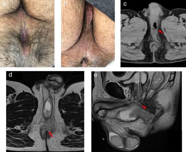 This composite educational image illustrates the clinical and radiological presentation of a perianal abscess with perineal involvement. Panels (a) and (b) are clinical photographs: (a) shows a normal appearing perianal region, while (b) demonstrates mild erythema across the perineum. Panel (c) is an axial non-contrast CT scan of the pelvis showing an air-containing, low-density collection in the perineum (red arrow) indicative of an anaerobic or gas-forming infection. Panels (d) and (e) are T2-weighted MRI scans in axial and sagittal planes, respectively. The axial MRI (d) highlights a high-intensity fluid signal at the 12 o'clock position relative to the anal canal, suggesting the primary track of the abscess. The sagittal MRI (e) confirms the continuity of the fluid collection with the anal canal and its anatomical position posterior to the bladder. This case highlights the importance of multi-modal diagnostic imaging (CT and MRI) for identifying deep-seated infections when external clinical signs, such as perianal redness, may be minimal or absent.