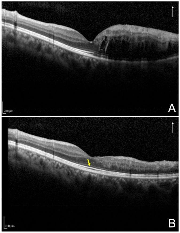 This diagnostic comparison presents two vertical optical coherence tomography (OCT) B-scans of a human retina, demonstrating the progression and resolution of macular edema secondary to branch retinal vein occlusion (BRVO). Panel A (Initial Visit) shows a cross-section of the fovea with significant intraretinal fluid (IRF) manifesting as large, hyporeflective cystic spaces. This accumulation results in marked retinal thickening and the loss of normal foveal contour, classified as 'one-side IRF' as the fluid is predominantly localized to one side of the foveola. Panel B (12-Month Follow-up) illustrates the post-treatment state, showing complete resolution of the intraretinal fluid and restoration of a more anatomical retinal thickness and profile. A yellow arrow highlights the intact and continuous ellipsoid zone (EZ) band, signifying the preservation of photoreceptor integrity. White arrows in the upper right corners indicate the vertical scan orientation. These images serve as an educational example of treatment efficacy and the importance of monitoring outer retinal layers, such as the EZ band, for visual prognosis in vascular retinal diseases.