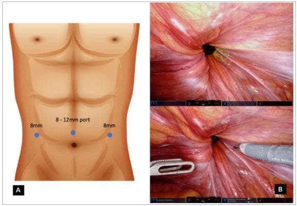 Educational medical composite illustrating robotic inguinal hernia repair. Panel A is an anatomical diagram showing abdominal port placement on a male torso; it highlights a central supraumbilical port (8-12 mm) flanked laterally by two 8 mm robotic ports, essential for the da Vinci surgical system setup. Panel B displays a robotic intraoperative view of the internal inguinal region. The image shows the inguinal defect as a dark, circular opening within the reddish-pink peritoneal tissue. Distinct anatomical landmarks such as the medial umbilical ligament and the radiating striated texture of the abdominal wall are visible. Robotic surgical instruments, including a dissector and a grasping tool, are shown targeting the defect area for dissection and preparation of the preperitoneal space. This visual material demonstrates the surgical approach and anatomical orientation required for robotic-assisted transabdominal preperitoneal (rTAPP) hernia repair.