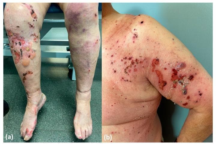This clinical photograph displays two distinct phenotypes of Bullous Pemphigoid (BP) associated with DPP4 inhibitors (DPP4i). Image (a) represents a non-inflammatory, drug-induced phenotype localized to the lower extremities. The left leg shows large, tense subepidermal blisters (bullae), areas of denuded skin with exposed dermis, and serous weeping, while the right leg exhibits scattered erythematous macules and smaller vesicles. Image (b) demonstrates an inflammatory, drug-triggered phenotype on the right shoulder and upper arm. This presentation is characterized by a polymorphic eruption including widespread erythematous papules, urticarial plaques, and multiple hemorrhagic erosions with significant crusting and exudate. The surrounding skin shows marked inflammation (erythema), typical of the classic BP presentation involving NC16A autoantibodies. These images serve as a comparison of morphological variations in drug-associated autoimmune blistering diseases, highlighting the difference between a primarily bullous, non-inflammatory presentation and an erosive, highly inflammatory cutaneous response.