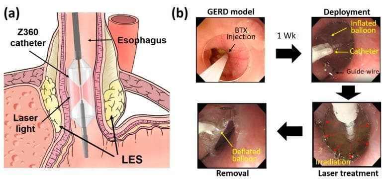 Educational figure illustrating Endoscopic Balloon-assisted Laser Treatment (EBLT) for Gastroesophageal Reflux Disease (GERD). (a) Anatomical diagram showing a Z360 balloon catheter positioned within the distal esophagus at the lower esophageal sphincter (LES). The catheter features a transparent inflated balloon and a central diffusing applicator that emits circumferential laser light to target the LES muscle layers. (b) A series of four endoscopic frames detailing the procedural stages in a porcine model: 1. GERD model induction via botulinum toxin (BTX) injection to weaken the LES; 2. Deployment stage showing the catheter and inflated balloon guided by a guide-wire; 3. Laser treatment stage showing active irradiation (indicated by red arrows); 4. Removal stage following balloon deflation. The educational focus is on the minimally invasive delivery of laser energy to the esophagogastric junction to induce tissue remodeling and increase LES pressure without mucosal injury.
