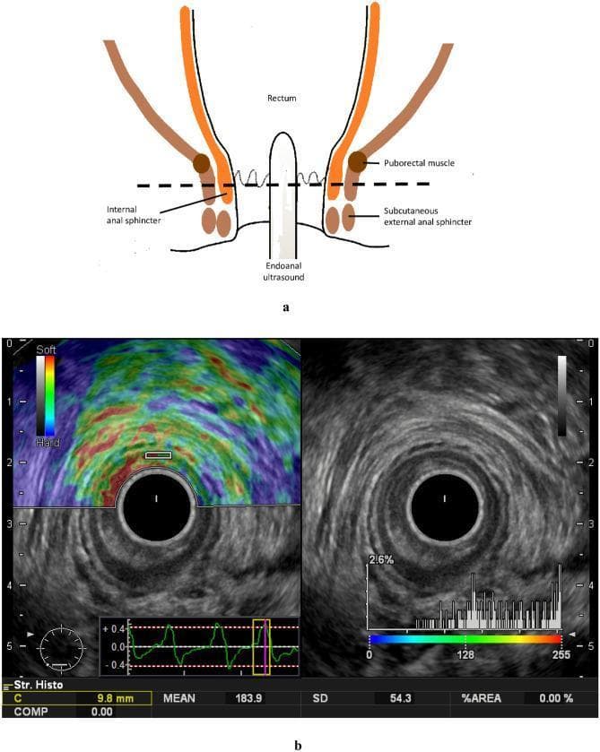 This composite educational image illustrates the application of endoanal ultrasound and real-time tissue elastography (RTE) for assessing anal sphincter anatomy and elasticity. Figure 'a' is a schematic diagram showing an endoanal rectal probe positioned within the anal canal, identifying key landmarks including the rectum, puborectalis muscle, internal anal sphincter (IAS), and subcutaneous external anal sphincter (EAS). Figure 'b' presents dual-panel imaging: the right panel shows a transverse B-mode ultrasound image displaying concentric anatomy of the anal canal. A hypoechoic inner ring (indicated by a white arrow) represents the IAS, surrounded by a more heterogeneous, higher-echogenicity layer (indicated by a yellow arrow) representing the EAS. The left panel shows the corresponding real-time tissue elastography image, where a color-coded strain map is superimposed on the B-mode image. A color scale indicates tissue stiffness (blue/green for softer tissue, red/yellow for harder tissue). Quantifiable data, including a histogram of elasticity values (0–255 range) and mean strain values, are visible at the bottom, demonstrating the methodology for evaluating IAS sclerosis or stiffness changes following clinical interventions like chemoradiotherapy.