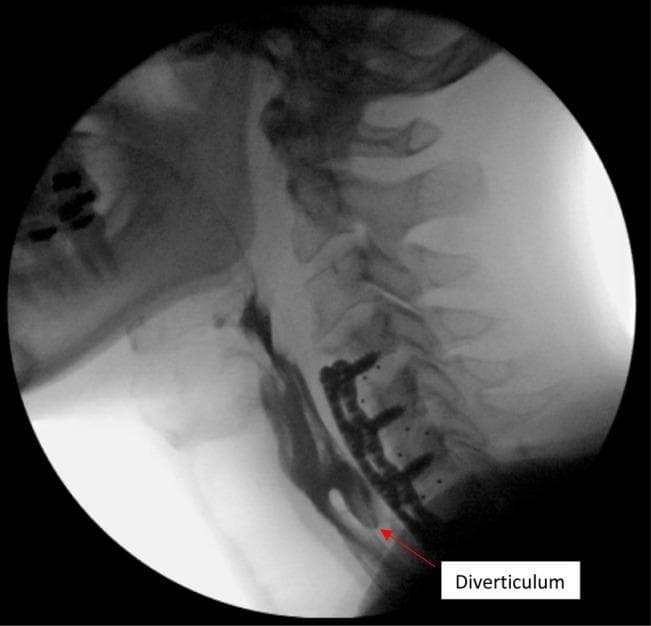 This lateral view barium swallow (esophagram) demonstrates the cervical spine and esophagus in a patient with a history of anterior cervical discectomy and fusion (ACDF). The image shows radiopaque orthopedic hardware consisting of a plate and multiple screws extending from C4 to C7. The contrast-filled esophagus is visible posterior to the hardware. A prominent outpouching or sac, labeled as a 'Diverticulum', is seen originating from the anterior aspect of the esophagus near the lower margin of the cervical plate. The diverticulum is filled with barium and shows smooth, rounded borders. While the location and appearance may mimic a Zenker diverticulum, the clinical context and visual proximity to the instrumentation suggest an ACDF-related diverticulum or an acquired traction diverticulum possibly related to hardware irritation or chronic esophageal wall compromise. The study highlights the anatomical relationship between spinal instrumentation and the aerodigestive tract, relevant for evaluating postoperative dysphagia.