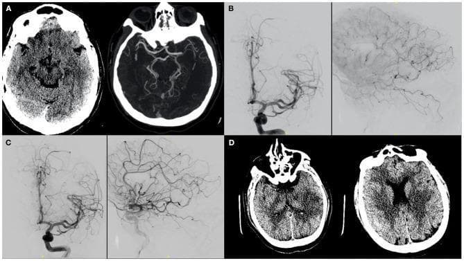 This composite figure displays diagnostic and interventional neuroimaging of a left middle cerebral artery (MCA) ischemic stroke. Panel A consists of a non-contrast axial head CT and CT angiography (CTA) Maximum Intensity Projection (MIP) showing an acute occlusion in the left M1 segment. Panels B and C are Digital Subtraction Angiography (DSA) images in AP and lateral projections. Panel B illustrates the cerebral vasculature after intravenous thrombolysis (IV tPA), showing migration of the thrombus into distal MCA branches with persistent distal filling defects. Panel C shows improved vessel patency and distal perfusion in the left MCA territory following targeted intra-arterial tPA administration. Panel D presents follow-up axial CT scans demonstrating the evolution of the infarct, visualized as regions of decreased parenchymal density (hypodensity) in the left putamen, temporal, and parietal lobes, consistent with established infarction in a large vessel occlusion territory. The series illustrates the clinical pathway from diagnostic imaging to mechanical/pharmacological intervention and final radiologic outcome.