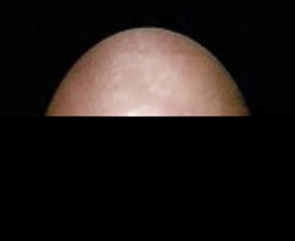 This clinical photograph shows a close-up view of an external fistula opening. The primary content type is a clinical photograph depicting a surgical or dermatological manifestation of perianal or abdominal disease. The tissue shown is pinkish-tan with a relatively smooth, dome-shaped contour against a dark, contrasting background. There are subtle variations in the surface texture and color, indicative of underlying soft tissue structures or the healing process of a fistulous tract. The image illustrates a stage of primary healing or the presence of a chronic external opening associated with a fistula-in-ano or similar tract. It is educationally relevant for medical students and clinicians studying colorectal surgery and wound healing, specifically focusing on the external morphology of fistulous communications between internal organs or tracts and the skin surface.