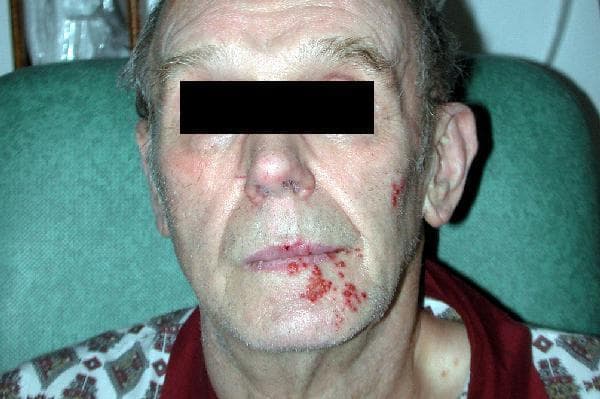 Clinical photograph of a male patient presenting with a localized vesicular rash on the face, characteristic of herpes zoster (shingles). The lesions consist of multiple grouped, erythematous papules and small vesicles, some showing signs of early crusting and ulceration. The distribution is strictly unilateral and dermatomal, primarily involving the mandibular (V3) and maxillary (V2) divisions of the trigeminal nerve. Clusters are most prominent around the right side of the vermillion border of the lower lip, extending inferiorly onto the chin and laterally toward the cheek. Additional smaller clusters are visible on the mid-cheek region. This image demonstrates a classic reactivation of the varicella-zoster virus (VZV), which can occur postoperatively following surgical manipulation of the trigeminal nerve, such as microvascular decompression for trigeminal neuralgia. The clinical focus is on the dermatomal pattern and the morphology of the herpetic vesicles.