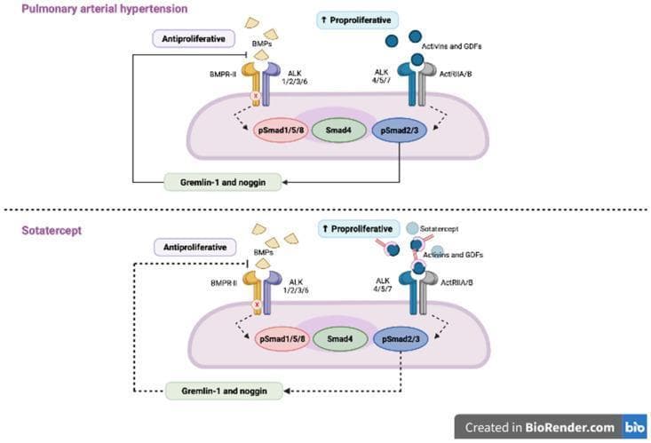 A comparative pathophysiology diagram illustrating the intracellular signaling pathways in pulmonary arterial smooth muscle cells during Pulmonary Arterial Hypertension (PAH) and the restorative effect of Sotatercept treatment. The upper panel depicts the PAH state, characterized by an imbalance between antiproliferative and pro-proliferative signaling. Impaired BMP signaling through BMPR-II/ALK 1/2/3/6 receptors leads to reduced pSmad1/5/8 activity. Concurrently, excessive Activins and GDFs bind to ActRIIA/B and ALK 4/5/7 receptors, upregulating pro-proliferative pSmad2/3 signaling. A feedback loop involving Gremlin-1 and Noggin further inhibits BMP signaling. The lower panel illustrates the mechanism of Sotatercept, a recombinant fusion protein. Sotatercept acts as a ligand trap, binding to Activins and GDFs to prevent their interaction with ActRIIA/B. This intervention suppresses the excessive pro-proliferative Smad2/3 pathway, indicated by dashed lines, thereby rebalancing the TGF-beta superfamily signaling toward an antiproliferative state. The diagram highlights key molecular targets in PAH therapy, including SMAD proteins and the ALK receptor family.