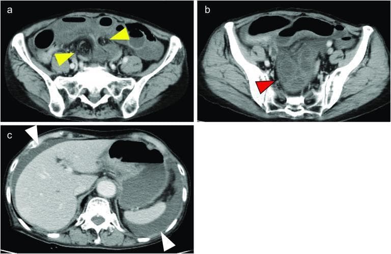 This composite diagnostic image features three axial slices (a, b, c) from a contrast-enhanced CT scan of the abdomen and pelvis, demonstrating a strangulated bowel obstruction. Panel 'a' shows the pelvic region where yellow arrows identify the hernia portal and the formation of a closed loop of the small bowel. In panel 'b', a red arrow indicates a dilated segment of the small bowel characterized by poor contrast enhancement, a visual finding highly suggestive of intestinal ischemia or necrosis due to compromised blood flow. Panel 'c' provides a superior view of the abdomen, with white arrows highlighting the presence of ascites, appearing as low-attenuation fluid collections around the liver and spleen. These findings are clinically relevant for diagnosing emergency surgical conditions such as ileo-ileal knots or internal hernias. The imaging is suitable for intermediate to advanced medical learners studying radiology, gastrointestinal emergencies, and surgical pathology.