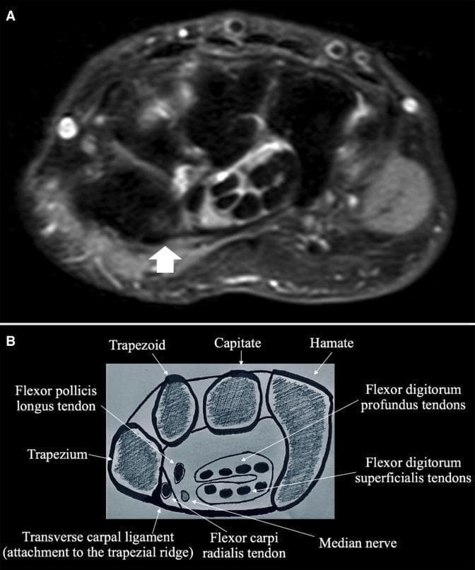 This composite educational graphic focuses on the wrist's carpal tunnel anatomy, consisting of an axial MRI image (A) and a corresponding labeled anatomical diagram (B). Image A is a proton density fat-suppressed (PD FS) MRI of a right hand, demonstrating the normal, low-signal intensity of an intact transverse carpal ligament (TCL). A white arrow indicates the ligament's lateral attachment point at the trapezial ridge. Image B provides a schematic cross-section at the same anatomical level, labeling key structures: the carpal bones (trapezium, trapezoid, capitate, and hamate), the median nerve, and various tendons including the flexor pollicis longus, flexor carpi radialis, flexor digitorum profundus, and flexor digitorum superficialis. The diagram clearly illustrates the TCL forming the roof of the carpal tunnel, specifically highlighting its lateral insertion on the trapezium. This comparison serves as a clinical reference for identifying normal TCL morphology and signal continuity, which is essential for diagnosing ligamentous tears or carpal tunnel pathology.