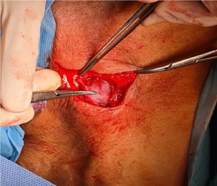 This clinical photograph displays an intraoperative view of an adenectomy, specifically a centered arcuate incision on the neck to address cervical lymph node tuberculosis (LNTB). The surgical field shows a small, transverse skin incision held open by surgical retractors and forceps. Centered within the incision is a prominent, whitish, ovoid structure consistent with an enlarged, encapsulated lymph node (adenopathy). The node exhibits a smooth, slightly translucent surface with minor superficial vascularization. The surrounding subcutaneous tissue appears erythematous and inflamed, with a small amount of surgical bleeding visible. The procedure illustrates the surgical management of a single large adenopathy or 'cold abscess' related to Mycobacterium tuberculosis infection. This image serves as an educational resource for ENT surgeons and medical students to identify the macroscopic appearance of tuberculous lymphadenitis and the technical approach for diagnostic or therapeutic excision.