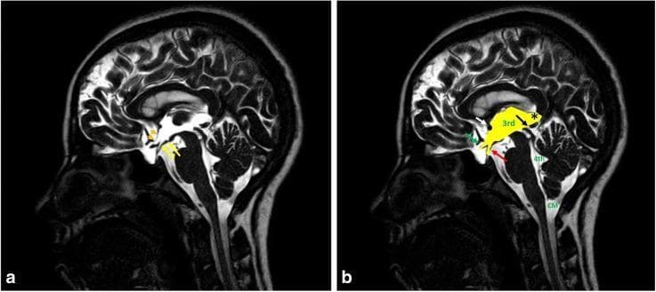 This diagnostic image consists of two sagittal midline high-resolution heavily T2-weighted MRI scans (3D-DRIVE sequence) of a 12-year-old male, illustrating normal ventricular and cisternal anatomy. Image (b) is annotated to highlight the cerebrospinal fluid (CSF) pathways, which appear hyperintense (bright white). Key structures identified include the third ventricle (3rd) with its concave floor (yellow arrows), the lamina terminalis forming the anterior border (orange arrowheads), and several functional recesses: the chiasmatic recess (green arrow), infundibular recess (red arrow), pineal recess (black arrow), and suprapineal recess (black asterisk). The anterior commissure is marked by a white arrow. The CSF pathway continues through the narrow aqueduct of Sylvius (white asterisk) into the fourth ventricle (4th), located dorsal to the pons. The cisterna magna (CM) is visible posterior to the medulla and cerebellum. This imaging modality is essential in pediatric neuro-radiology for evaluating hydrocephalus, aqueductal stenosis, and CSF flow dynamics by providing superior contrast between liquid CSF and neural parenchyma.
