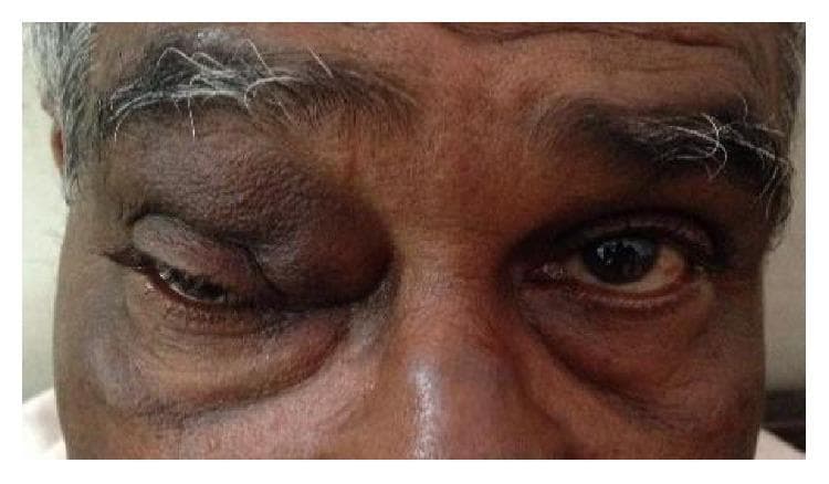 This clinical photograph shows a close-up, frontal view of an adult's face, highlighting significant facial asymmetry due to a mass in the left periocular region. The left upper eyelid displays a pronounced, firm-appearing swelling located superior and medial to the globe, consistent with an angular dermoid cyst. This mass causes mechanical ptosis, significantly narrowing the palpebral fissure compared to the unaffected right eye. The skin overlying the swelling appears intact without acute inflammatory signs like erythema or ulceration, though normal eyelid creases are obliterated. In contrast, the right eye serves as a baseline, showing normal eyelid position and periocular anatomy. This image is used to demonstrate the clinical presentation of orbital or adnexal dermoid cysts and their effect on eyelid mechanics and ocular symmetry within ophthalmology and dermatology training.