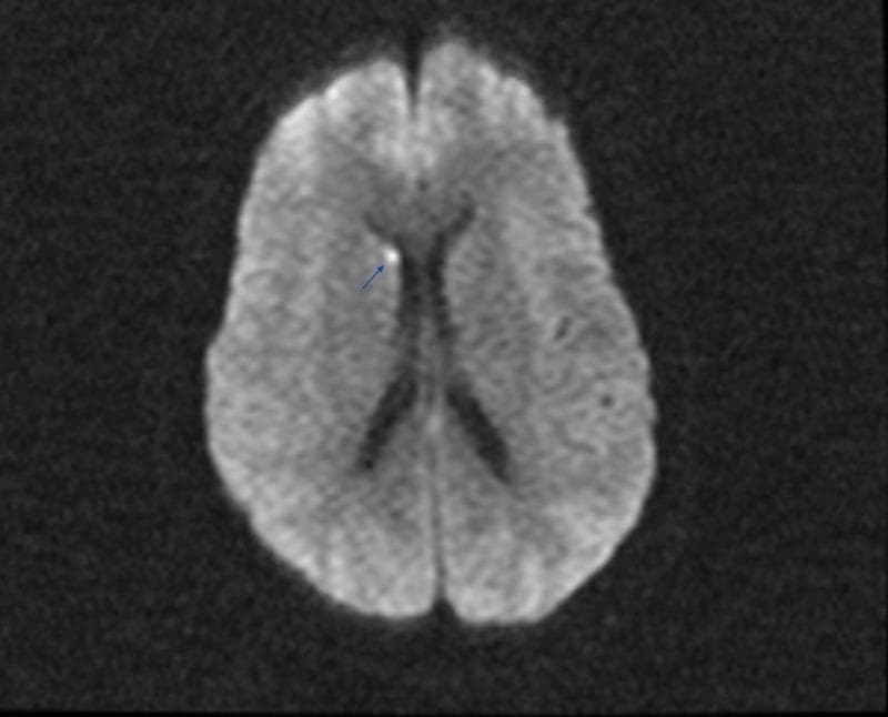 This diagnostic image is an axial slice of a brain MRI, specifically utilizing Diffusion-Weighted Imaging (DWI) or a similar high-contrast sequence to identify acute pathology. The image displays the cerebral hemispheres with visible sulci and gyri and centrally located, hypointense (dark) lateral ventricles. A focal, hyperintense (bright) signal abnormality is identified in the right hemisphere, specifically localized to the head of the caudate nucleus adjacent to the frontal horn of the lateral ventricle. This lesion is highlighted by a blue arrow and is clinically consistent with an acute lacunar infarct. The image is used to demonstrate the localization of small vessel ischemic strokes in patients presenting with encephalopathy or focal neurological deficits, particularly in the context of metabolic derangements like Hyperosmolar Hyperglycemic Syndrome (HHS).