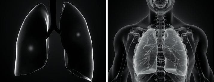 A dual-panel medical illustration titled 'Pathological diagram of severe pneumonia' providing a comparative anatomical view of the human respiratory system. The left panel shows an isolated 3D anatomical model of the lungs and trachea against a black background. The lung surfaces appear smooth and dark, with subtle highlights suggesting three-dimensional volume and lobar structure. The right panel displays the lungs integrated into a full-body sagittal-view silhouette of a human torso. This panel reveals the internal architecture of the respiratory tree, including the branching patterns of the bronchi and bronchioles within the lung parenchyma. The skeletal framework, including the rib cage, clavicles, and vertebral column, is visible as a translucent overlay. This educational visual is designed to demonstrate the relationship between external lung morphology and internal airway distribution, specifically contextualizing the sites of parenchymal inflammation and consolidation typical in severe pneumonia cases for medical students and clinical trainees.