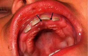 This clinical photograph displays a 1-month postoperative follow-up of a pediatric patient's maxillary arch and hard palate following the excisional biopsy of a pyogenic granuloma. The intraoral view shows the primary deciduous incisors and canines. Two black arrows indicate the previous surgical site on the palatal gingiva, adjacent to the upper left first deciduous incisor. The tissue at the site of the diode laser excision demonstrates complete mucosal healing with no signs of tumor recurrence. The gingiva appears healthy, pink, and well-keratinized, with a smooth texture that matches the surrounding palatal rugae and mucosa. There is no evidence of inflammation, edema, or residual scarring. The primary dentition is properly spaced, and the surrounding oral structures appear within normal physiological limits for an infant. This image serves as a reference for successful soft tissue healing and recurrence monitoring after surgical intervention for benign oral lesions in pediatric patients.