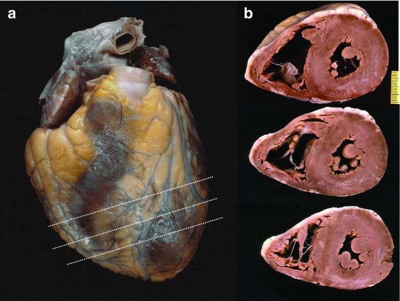 This clinical photograph illustrates the standard pathological procedure for short-axis cross-sectioning of a human heart specimen. Panel A shows a gross external view of the intact heart, displaying yellowish-tan epicardial fat and dark reddish-brown myocardial surfaces. Three transverse white dotted lines indicate the planned parallel sectioning levels starting from the mid-ventricular region towards the apex. Panel B displays the resulting three transverse (short-axis) slices. These sections demonstrate the characteristic cardiac anatomy: a thick-walled, circular left ventricular cavity and a thinner, crescent-shaped right ventricular cavity. Within the left ventricle, prominent papillary muscles and chordae tendineae are visible. The myocardium and endocardium can be assessed across these serial levels to identify pathological changes such as hypertrophy, infarction, or fibrosis. This technique is a fundamental component of forensic and clinical autopsy protocols for evaluating myocardial disease and ventricular morphology.