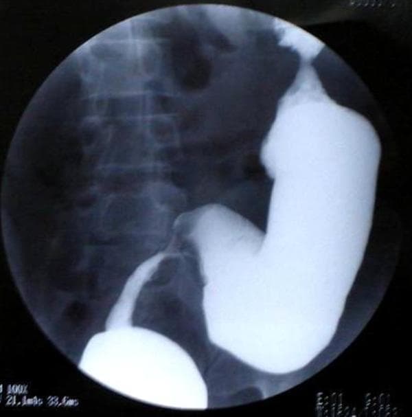 A diagnostic image showing a barium enema examination of the lower gastrointestinal tract. The radiograph displays a significant luminal narrowing, or stricture, located in the rectosigmoid region of the colon. The barium contrast agent clearly outlines a transition from a normal, dilated colonic diameter to an abruptly constricted, irregular channel where the lumen is markedly reduced. This finding suggests a partial obstruction. The surrounding anatomical context includes the lumbar vertebrae and the sacrum, visible in the background. The image is used for clinical education in gastroenterology and radiology to demonstrate the radiographic presentation of colonic strictures, which may be associated with inflammatory bowel disease, tuberculosis, or primary malignancies such as plasmacytoma of the colon.