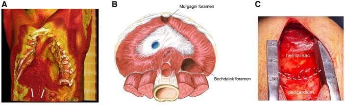 A multi-panel medical figure illustrating a Morgagni diaphragmatic hernia through diagnostic imaging, anatomical diagrams, and surgical photography. Panel A displays a 3D pre-operative angio-CT scan reconstruction, where a voluminous hernial sac containing omentum is color-coded red, positioned anterior to the yellow-coded pericardium. White markers indicate the diaphragmatic defect edges. Panel B is an anatomical illustration showing the superior view of the diaphragm, highlighting the anterior Morgagni foramen and the posterolateral Bochdalek foramen for comparative diagnosis. Panel C is an intraoperative photograph during a median sternotomy. Retractors expose the mediastinum, showing the physical relationship between the hernial sac and the pericardium, separated by a dashed white line indicating the boundary for dissection. This figure demonstrates the clinical presentation, anatomical basis, and surgical appearance of a rare adult Morgagni hernia causing significant cardiac compression.