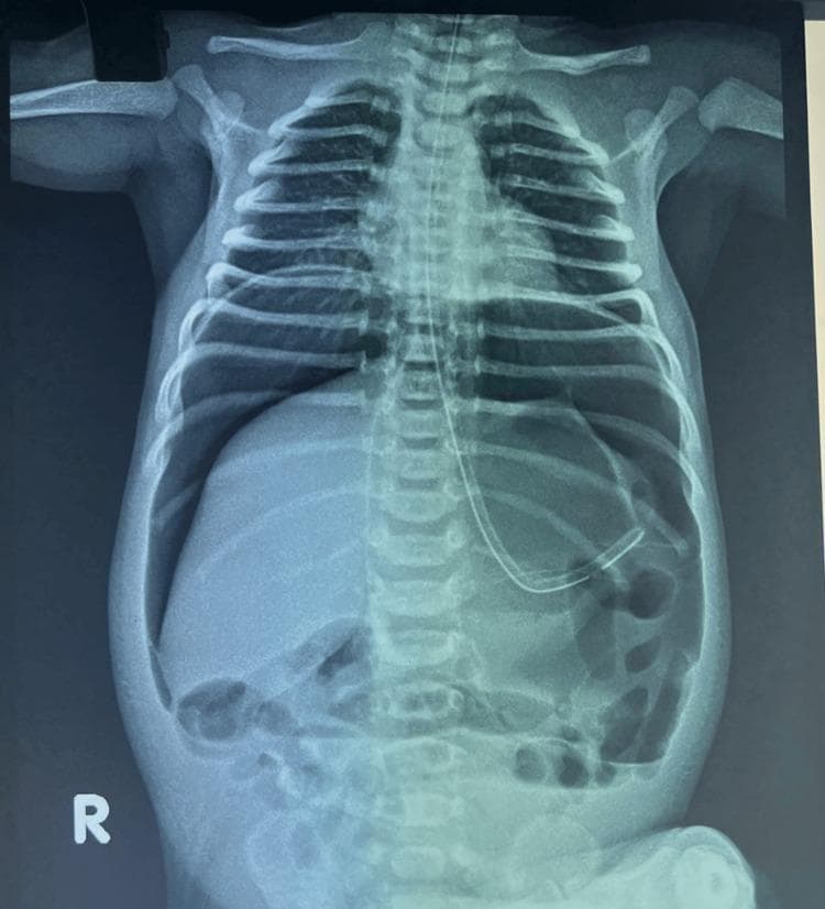 This diagnostic image is an erect abdominal X-ray of a neonate demonstrating massive pneumoperitoneum. Key radiological signs include the 'continuous diaphragm sign,' characterized by free gas outlining the entire lower surface of the diaphragm, and the 'football sign,' seen as a large, oval-shaped radiolucency within the abdominal cavity resembling an American football. Additionally, the 'falciform ligament sign' is visible as a vertical linear density in the upper right quadrant, highlighted by gas on both sides. A radiopaque orogastric tube is positioned with its distal tip in the stomach. The thoracic cavity shows clear lung fields and normal bony structures. These findings are highly suggestive of a hollow viscus perforation, such as neonatal gastric perforation. The image serves as a classic educational example of extra-luminal free air in a pediatric patient, emphasizing the importance of recognizing specific signs of intestinal or gastric emergency on plain radiography.