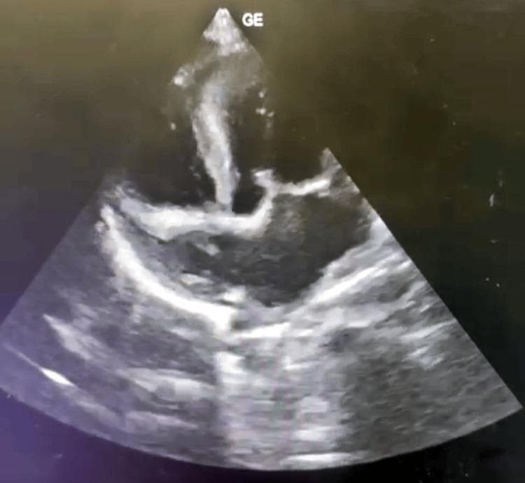 This diagnostic image is a 2D transthoracic echocardiogram in a parasternal long-axis (PLAX) orientation, illustrating hallmark features of Hypertrophic Obstructive Cardiomyopathy (HOCM). The ultrasound shows significant asymmetrical septal hypertrophy, where the interventricular septum (IVS) is markedly thickened compared to the posterior wall of the left ventricle. This septal bulging narrows the left ventricular outflow tract (LVOT), creating a substrate for dynamic obstruction. The image also captures the relationship between the hypertrophied septum and the anterior leaflet of the mitral valve, which often exhibits systolic anterior motion (SAM) in such clinical presentations. The increased echogenicity of the myocardial tissue in the septal region suggests densification or fibrosis consistent with cardiomyocyte disarray. This imaging modality is essential for evaluating cardiac structural abnormalities, assessing blood flow velocities, and measuring peak gradients across the LVOT to determine the severity of obstructive cardiac conditions in pediatric or adult cardiology.
