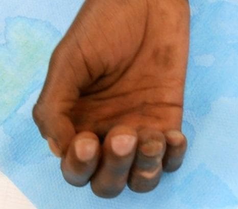 This clinical photograph displays a right hand exhibiting a classic ulnar claw deformity (griffe cubitale). The hallmark postural abnormality is evident in the 4th (ring) and 5th (little) fingers, which show hyperextension at the metacarpophalangeal (MCP) joints and marked flexion at the proximal interphalangeal (PIP) and distal interphalangeal (DIP) joints. This presentation is characteristic of ulnar nerve palsy, in this case, a sequela of leprosy. The palm shows hyperpigmented skin patches and induration of the integument, which are common dermatological manifestations of Hansen's disease. The thumb, index, and middle fingers appear relatively spared from the clawing posture, typical of a distal ulnar nerve lesion where the lumbricals of the first two fingers (innervated by the median nerve) remain functional. The image serves as an educational example of the neurological and musculoskeletal impact of chronic leprosy on hand function and morphology.