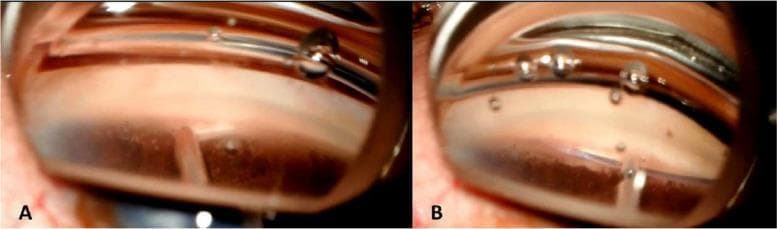 This clinical procedural image consists of two panels (A and B) demonstrating the intraoperative steps of Gonioscopy-Assisted Transluminal Trabeculotomy (GATT), a minimally invasive glaucoma surgery (MIGS). The view is obtained via an ab interno approach through a surgical goniolens, visualizing the nasal anterior chamber angle. Panel A shows the initial step where a 25-gauge needle is used to create a focal goniotomy, incising the trabecular meshwork to expose the underlying Schlemm's canal. Panel B illustrates the subsequent cannulation phase, where a 5-0 Prolene (polypropylene) suture wire is inserted through the goniotomy and advanced 360 degrees into the lumen of Schlemm's canal, guided by 23-gauge microforceps. Key anatomical landmarks visible include the clear cornea with surgical air bubbles, the pigmented trabecular meshwork band, and the iris periphery. This procedure is performed to reduce intraocular pressure by bypassing the primary site of aqueous outflow resistance.