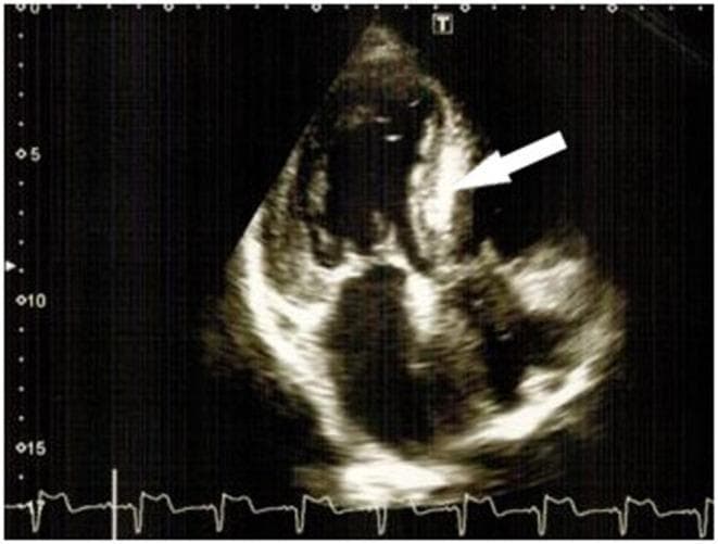 This diagnostic image is a 2D transthoracic echocardiogram in an apical four-chamber view, demonstrating hallmark features of restrictive cardiomyopathy, specifically cardiac amyloidosis. The visual highlights significant concentric left ventricular hypertrophy (LVH) with a markedly thickened interventricular septum. A white arrow points to the 'characteristic luminescence' or 'sparkling' appearance of the myocardial tissue, which indicates increased echogenicity due to amyloid protein deposition. Both atria appear moderately dilated, which is consistent with the restrictive filling pattern and diastolic dysfunction typical of infiltrative heart diseases. The image also captures a concurrent ECG strip at the bottom for cardiac cycle timing. Key educational concepts illustrated include the visualization of myocardial texture changes, wall thickening (hypertrophy), and chamber enlargement as diagnostic indicators for amyloid-related cardiac involvement.
